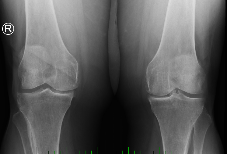 osteoartróza, gonartroza 